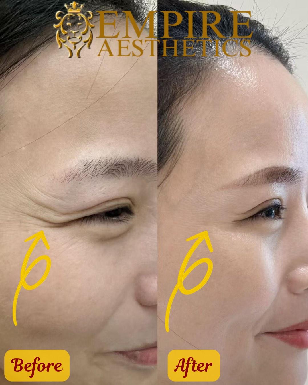 Crow's Feet Botox: Smooth Eye Wrinkles + Consult