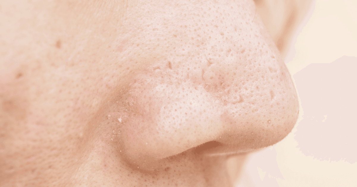 Embossed Scar Laser Package: CO2 + Glass Skin Facial