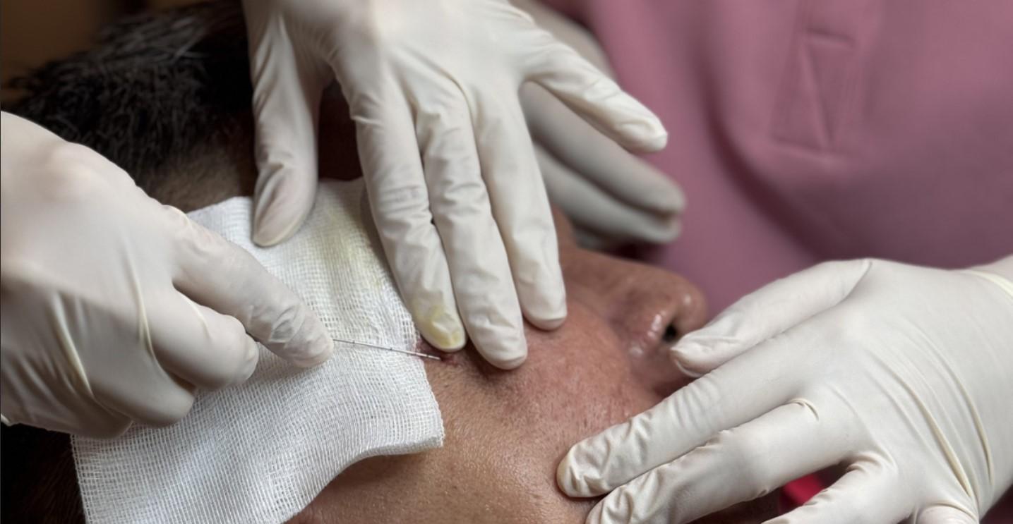 Fractional CO2 Laser + Subcision Acne Scar Treatment