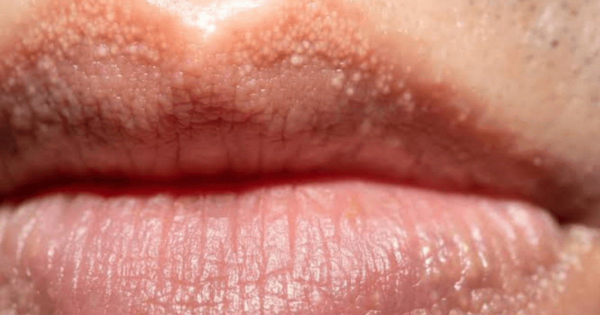 Fordyce Spots Removal via Electrosurgery