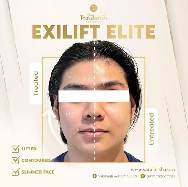 Exilift Ultra Skin Tightening for Face