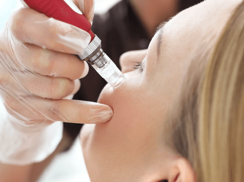 Vampire Facial (PRP) + PDT Light Therapy Session