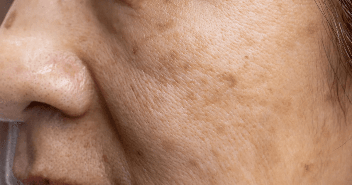 Melasma Laser Rejuvenation + FREE Skin Care Set
