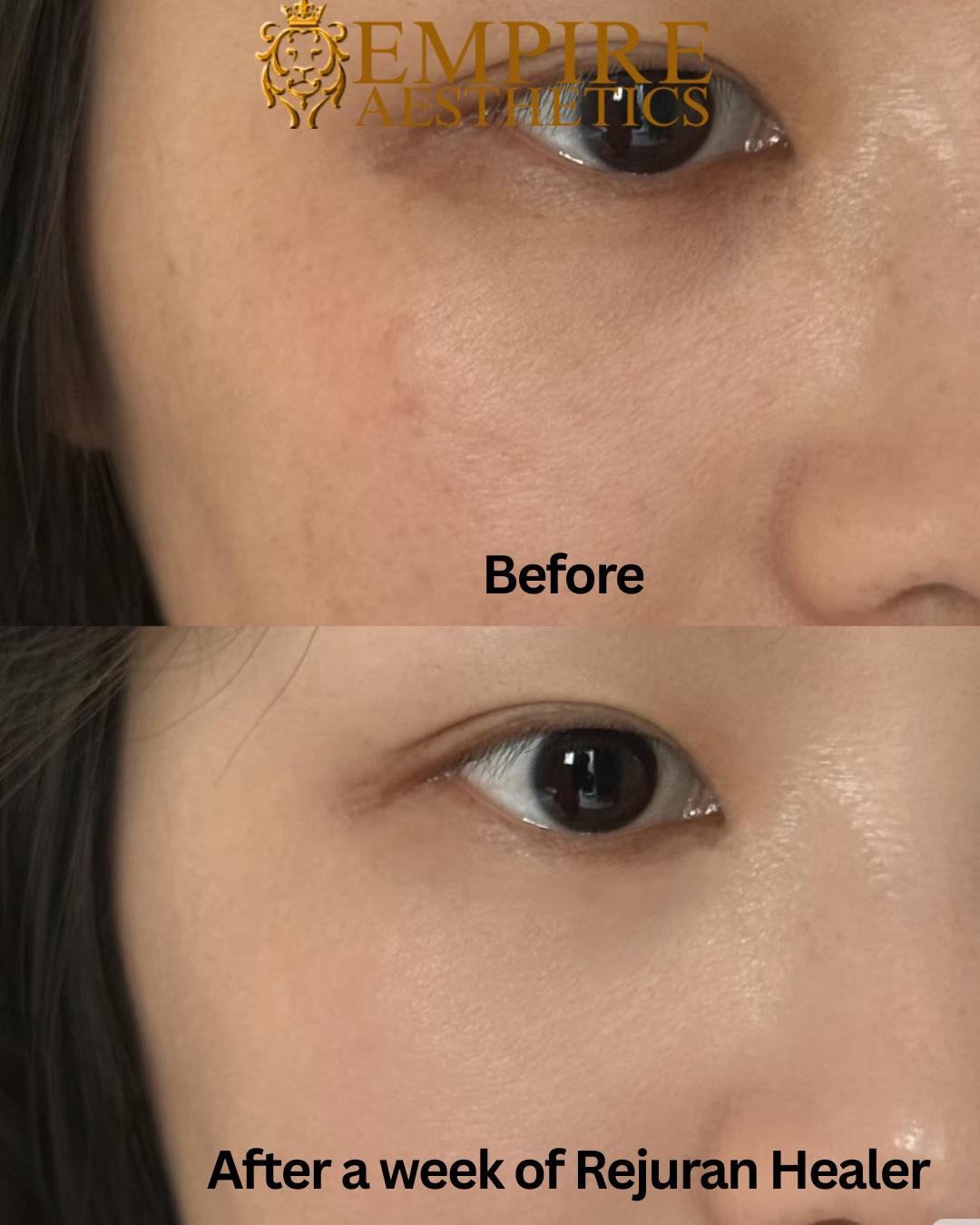 Rejuran Healer, 2 Sessions + Skin Consultation