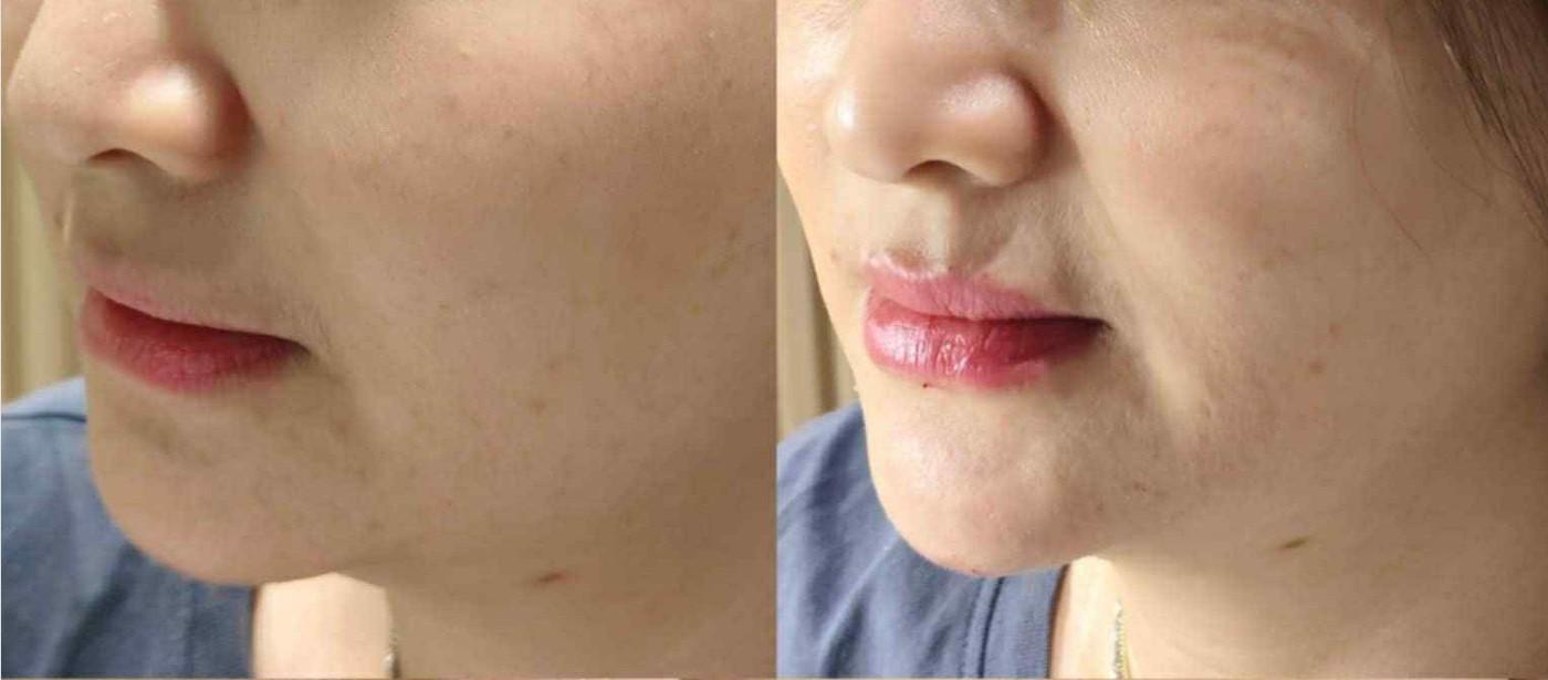 Lip Fillers for Plump, Defined Lips, Hyaluronic Acid